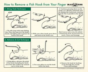 Comment enlever un hameçon piqué dans un doigt